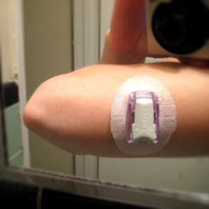Dexcom sensor cradle with transmitter, affixed to the back of my upper arm